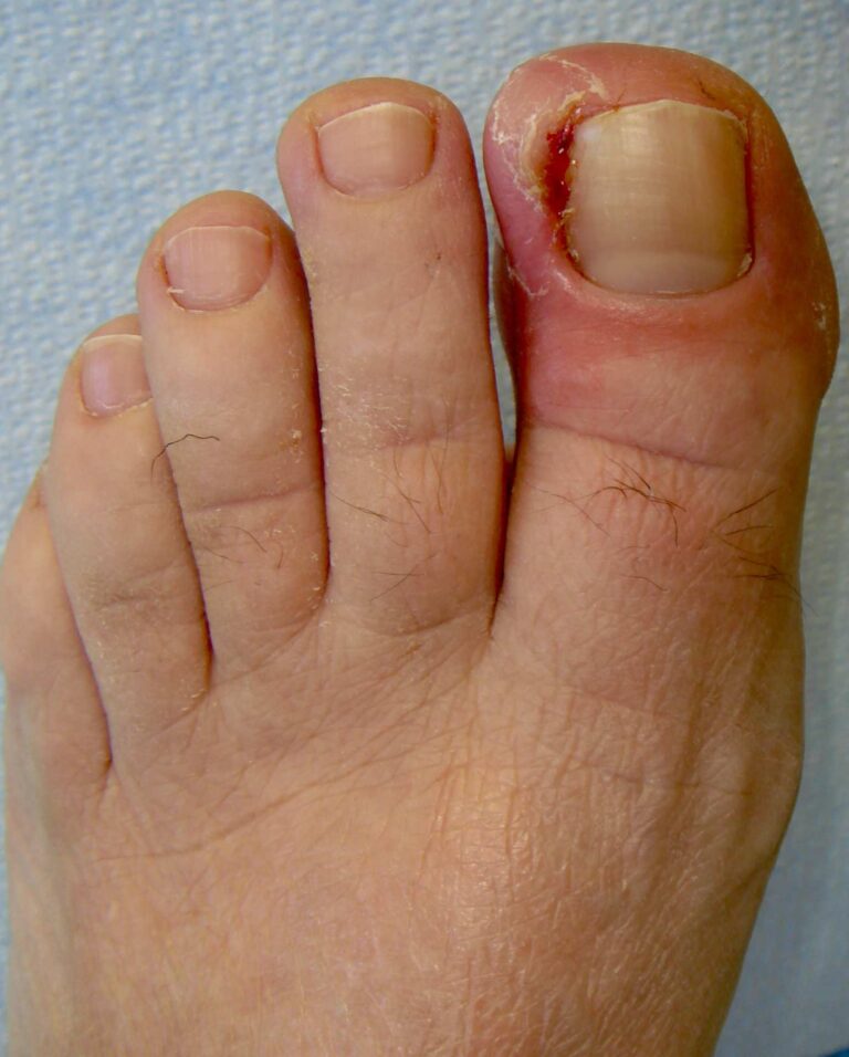 Ingrown Toenails Symptoms And Solutions Da Vinci Foot And Ankle