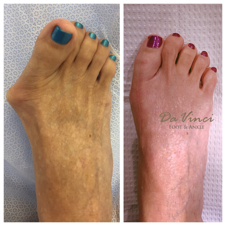 Bunion Surgery Augusta Removal Treatment Bunionplasty