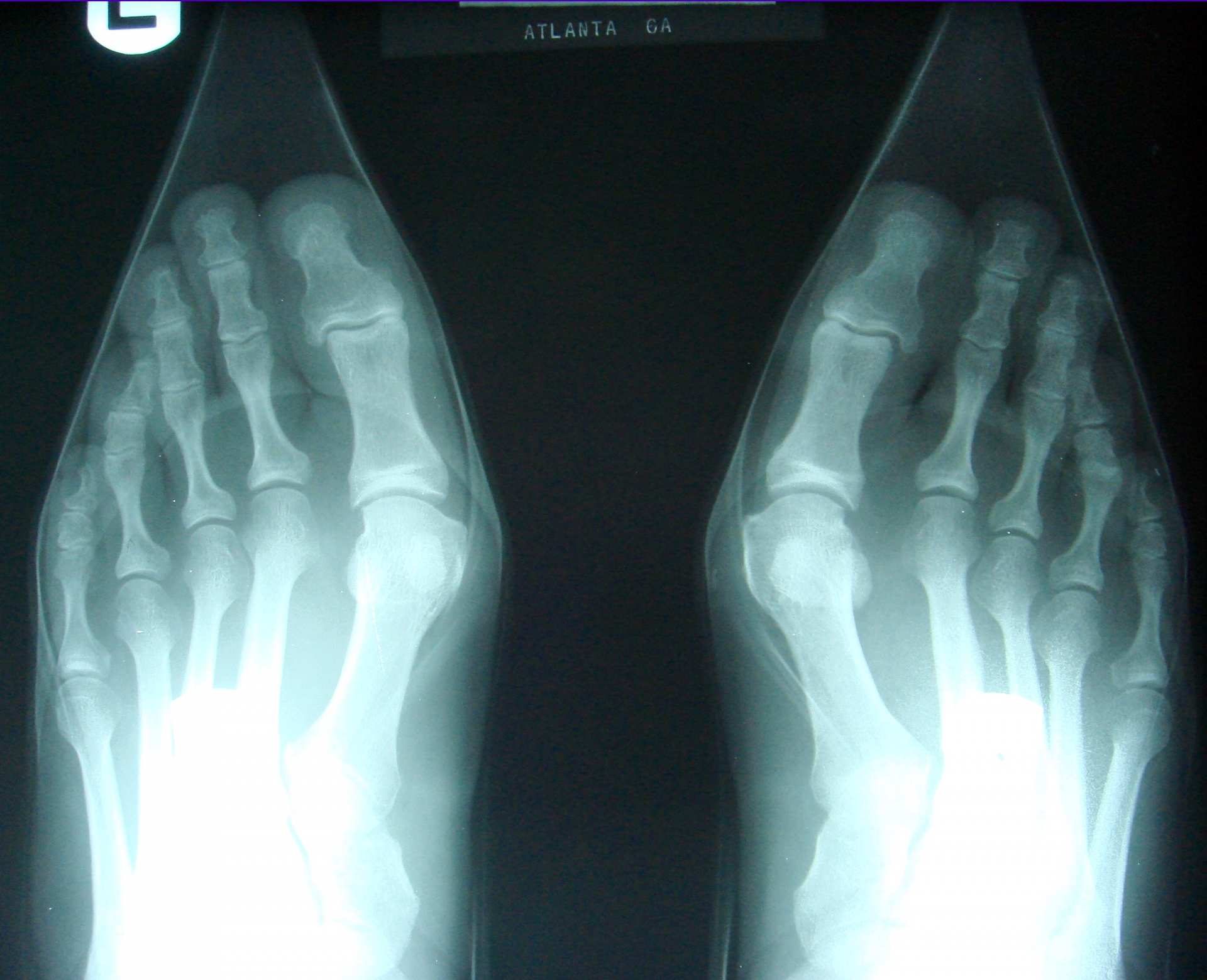 Images of Bunions