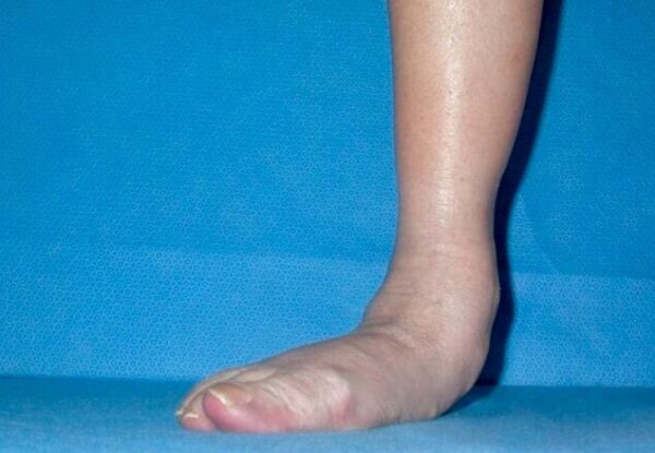 Da Vinci Foot and Ankle Flat Foot