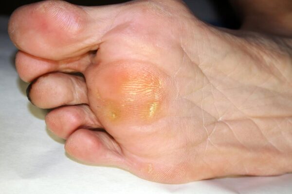 Callus removal from feet: balls of feet 