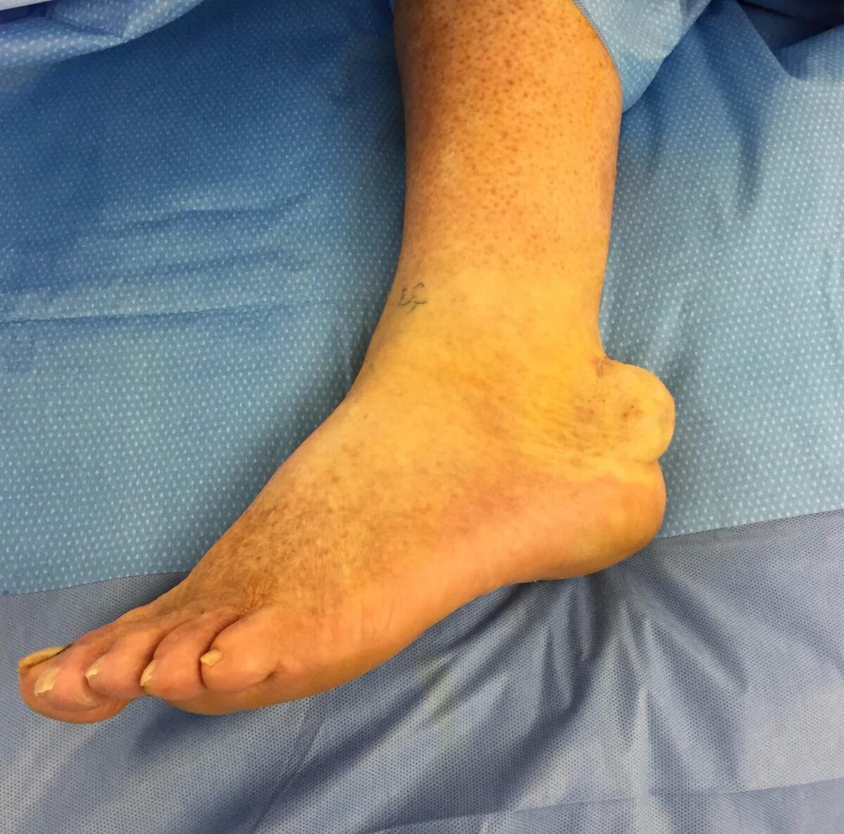 Soft Tissue Mass Removal – Da Vinci Foot & Ankle