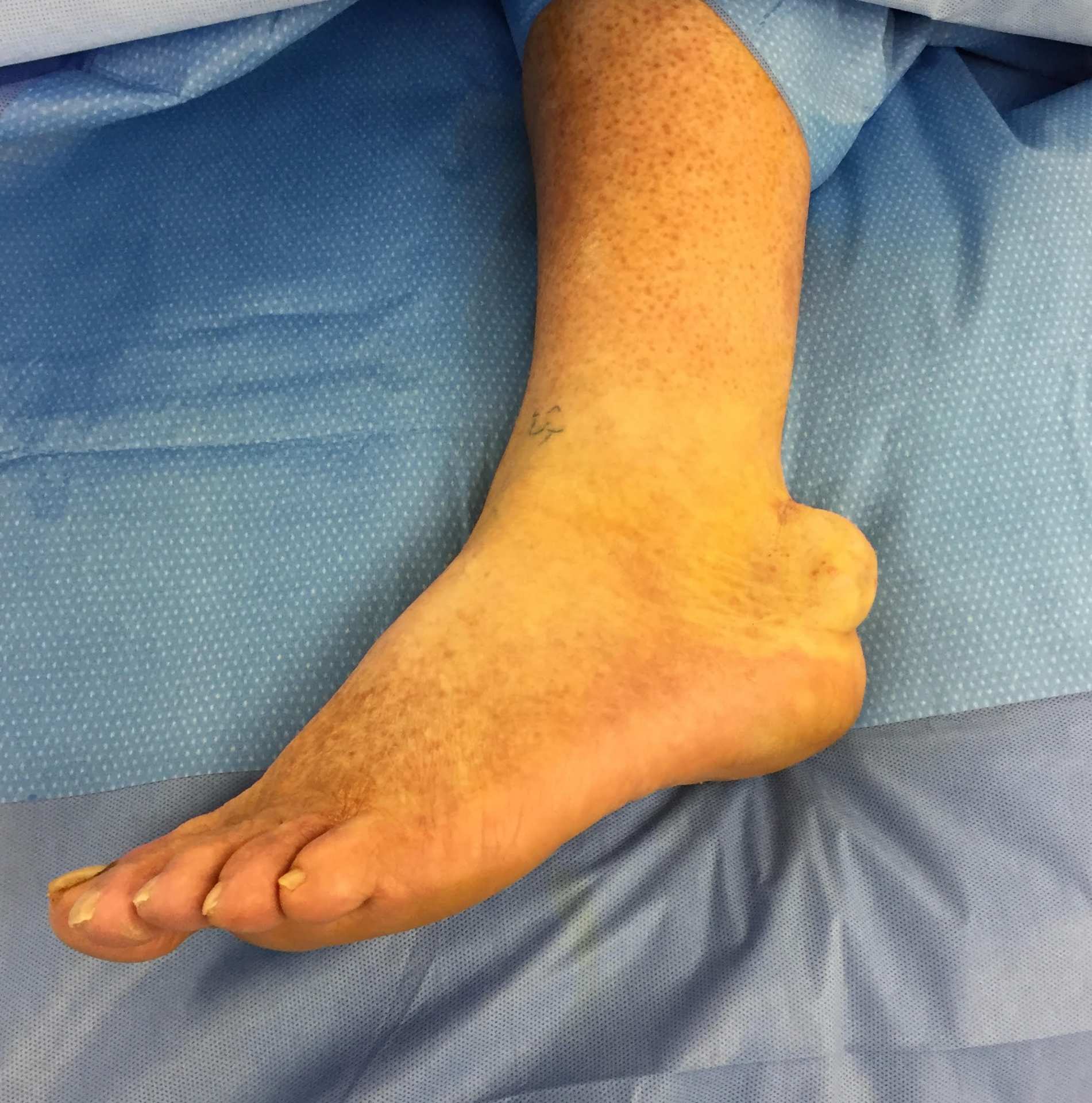 Soft Tissue Mass Removal - Da Vinci Foot and Ankle