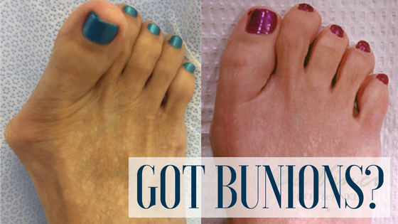 Bunion Surgery – Is it right for you?