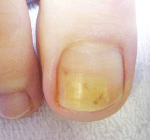 What Can Be Done About A Thick and Painful Toenail? – Scott R