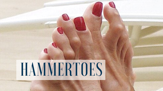 Hammertoes – Everything You Need to Know