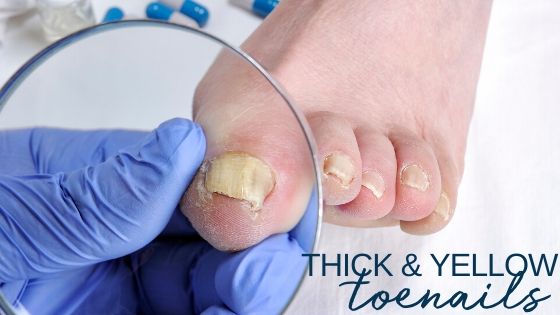 Thick Toenails – Symptoms, Diagnosis and Treatment